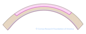 Courtesy of Cornea Research Foundation of America - www.cornea.org
