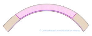 Courtesy of Cornea Research Foundation of America - www.cornea.org